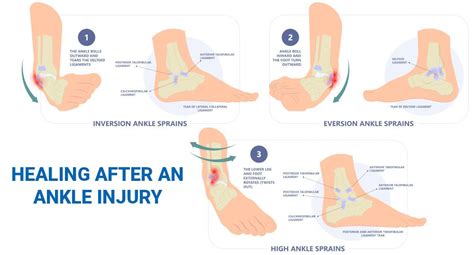 How to Recover from an Ankle Sprain QiVantage