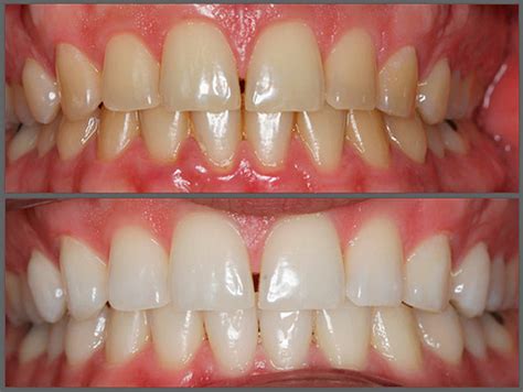 How to Remineralize & Regrow Tooth Enamel Teeth health, Health