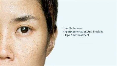 How to Remove Hyperpigmentation and Freckles Tips and Treatment