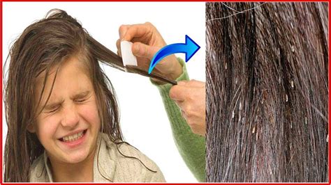 How to Remove Nits from Hair?