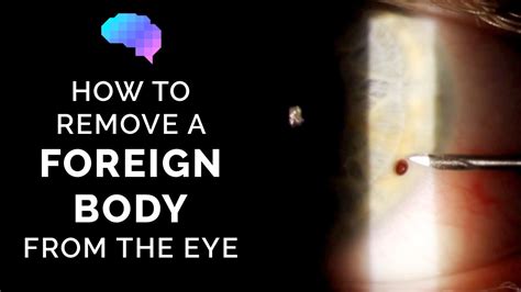 How to Remove a Foreign Body From Your Eye - YouTube