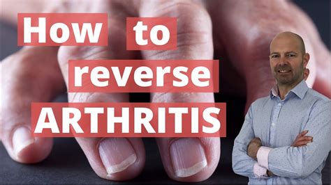 How to Reverse Arthritis, Say Experts - Yahoo