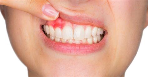 How to Reverse Gingivitis: The Ultimate Guide