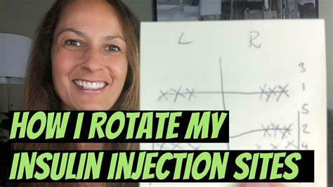 How to Rotate Insulin injection sites? Dr Rahul Reddy - YouTube