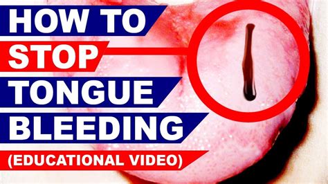 How to Stop Tongue Bleeding - Common Ailments - Home …