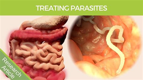 How to Test and Treat Intestinal Parasites YouTube