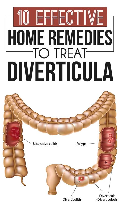 How to Treat Diverticulitis Symptoms- All Things Health