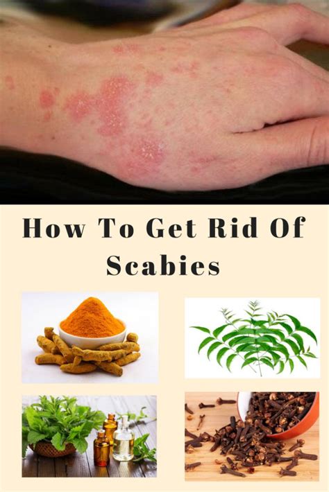 How to Treat Scabies DrGreene.com