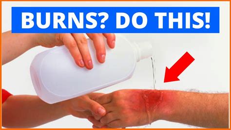 How to Treat a Burn on a Forearm Healthfully