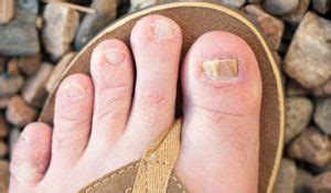 How to Use Eucalyptus Oil for Toenail Fungus - Fab Naturals