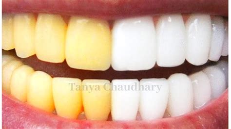 How to Whiten Yellow Teeth Naturally - eMediHealth - Top 10 …