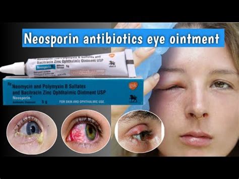 How to apply neosporin ointment in eye