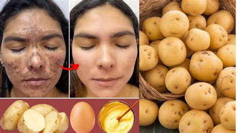 How to apply potato on face.  &bull; Heals dry skin.  Apply the grated potato directly t...