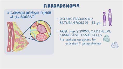 How to avoid breast fibroadenoma.  This comprehensive Conclusion In conclusion, while fibroad...