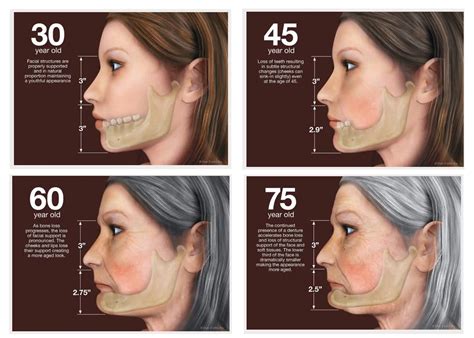 How to avoid denture face.  In this article, we’ll explore Although s...