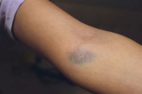 How to avoid hematoma in venipuncture
