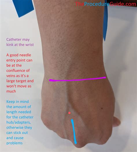 How to cannulate rolling veins.  Arm veins are easier to .  Example: Large...