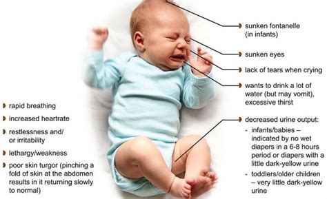 How to check for dehydration in infants
