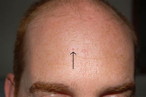Jun 7, 2019 · Here's what it says: "A Dilated pore of Winer is essentially a large, solitary open comedone/blackhead. Dead skin cells get trapped and help widen this pore, and plugs up the opening. The ... . 