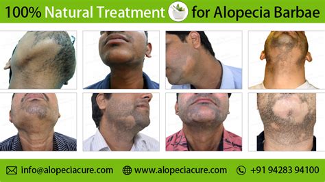 How to cure alopecia areata in beard