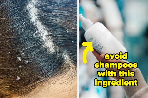 How to cure dandruff in winter