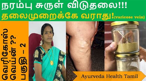 How to cure varicose veins in tamil