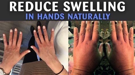 How to decrease swelling in hands