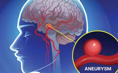 How to detect a brain aneurysm early