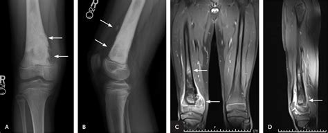 How to detect bone cancer in leg