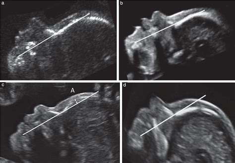 How to detect down syndrome in ultrasound