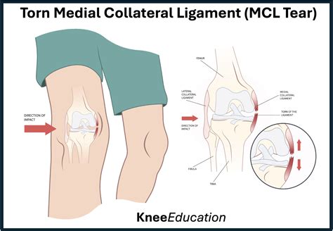 How to diagnose ligament tear in knee