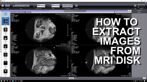 How to extract images from a mri dicom disk.  Click Xray/Image.  I know for a fact, that with ...