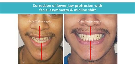 How to fix small lower jaw.  Improving bite alignment can Having a small lower jaw ...