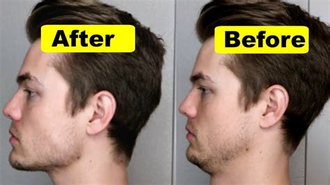 How to get a better jawline. 5. Goodbye, Double Chin. Hello, Jawline. Fat plays an integral role in a snatched jawline. When there is a bit too much of it under the chin, it can obscure the jaw’s sharp lines. “I’m seeing more patients at a younger age with double chins and skin sagging, which detracts from the jawline,” Dr. Emer notes. 