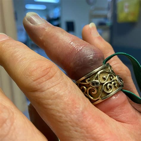 How to get a stuck ring off. When it comes to removing a ring jammed on a finger, the first step is to cool the skin down to reduce swelling as much as possible. Neil suggested placing the swollen finger in a bowl of ice ... 