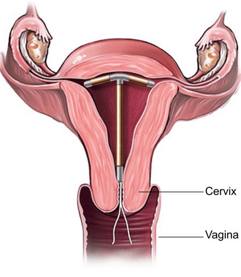 How to get an iud put in