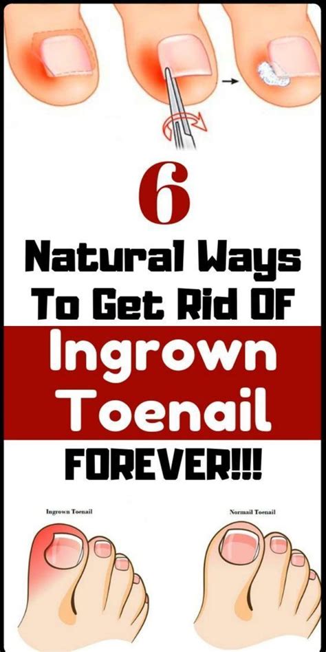 How to get out a ingrown toenail at home. .  ...