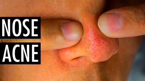 How to get rid of a big red spot on nose tip