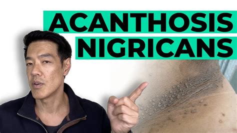 How to get rid of acanthosis nigricans.  This article will help you understand ...