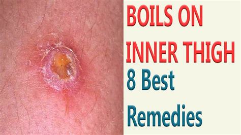 How to get rid of boils on inner thigh. There is not a quick way to get rid of a boil near your vagina. A boil often takes weeks to resolve completely. Antibiotics from your healthcare provider may help speed up the healing process. Do not try to squeeze or pop a boil to get rid of it. This can spread infection and cause scarring. Applying a warm compress several times a day to the area is the best … 