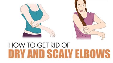 How to get rid of crusty elbows - easily - YouTube