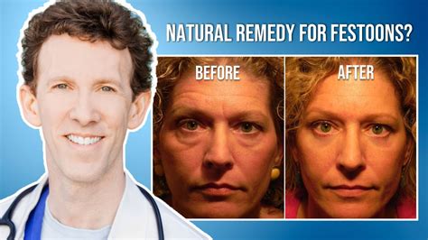 How to get rid of festoons naturally. GET.  Ultimately it probably doesn...