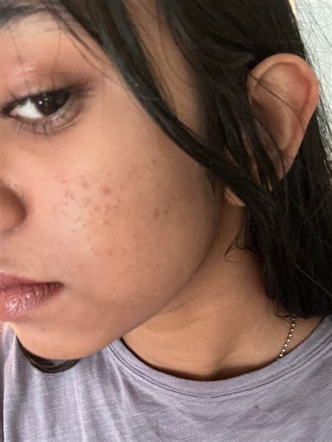 How to get rid of pih reddit.  It&rsquo;s commonly We would like to show you a description here but...