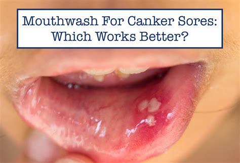 How to get rid of under tongue canker sore (Very Fast)