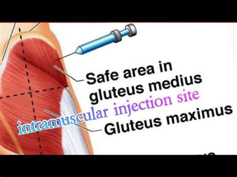 How to give injection in buttock