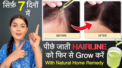 How to grow hairline in a week