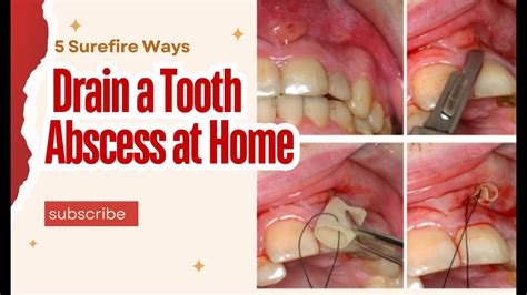 How to heal an abscess in mouth