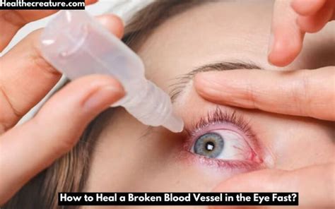 How to heal broken blood vessel in eye fast