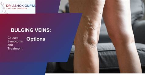 How to hit a vein that rolls.  1.  Bulging veins can be seen with inflammation...