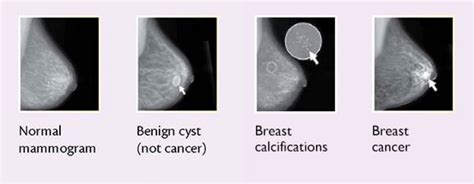 How to identify lump in breast
